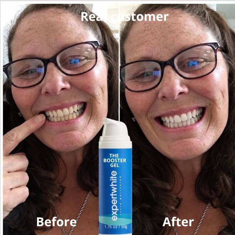 Rediscover a Brighter, Whiter, Younger-Looking Smile