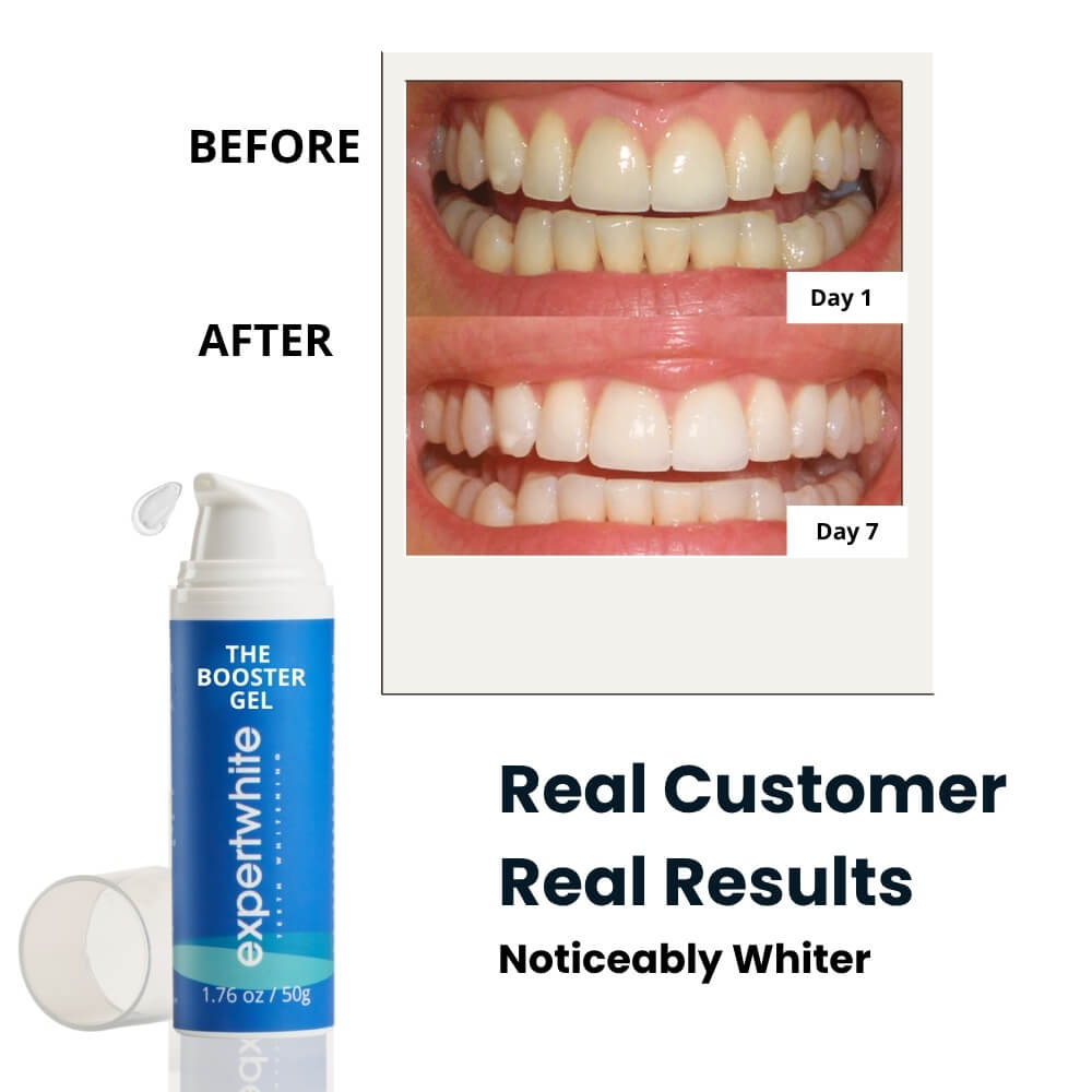 Rediscover a Brighter, Whiter, Younger-Looking Smile